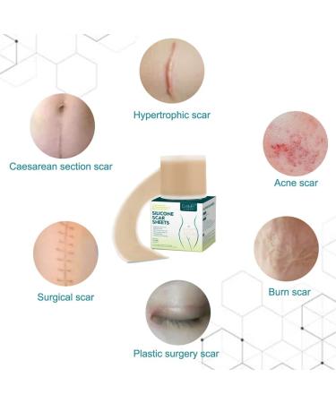 Medical Silicone Scar Tape Roll - 1.6'' x 120'' | Easy-Tear & Reusable | For Surgery, C-section, Keloid, Burns | 6-8 Month Supply - Buy Online on GoSupps.com