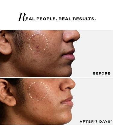 Novology Acne Clearing Serum 0.1% Terpinol Reduce Acne from Day 7 Co-Created with Dermatologists - Buy Online on GoSupps.com