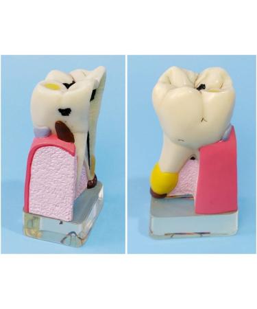 Dytah Dental Implant Model - Tooth Pathology & Crown Bridge Demonstration | Parodontal Sortal Teeth & Gums Educative Model for Dental Care - Buy Online on GoSupps.com