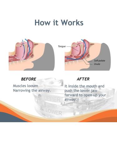 Anti Snoring Devices Effective Snoring Solution Adjustable and Reusable Stop Snoring Devices for Men and Women - Buy Online on GoSupps.com