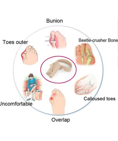 Bunion Relief Corrector Pad - Orthopedic Protector for Hallux Valgus Foot Pain - Toe Separators for Big Joint Tailors - Forefoot Cushion for Ball of Foot - Size Large - Buy Online on GoSupps.com