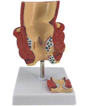YOtat Human Pathological Hemorrhoids Model-Colorectal Hemorrhoid Lesion Model-Placed On The Base-is The Best Teaching Aid for Doctor-Patient Communication - Buy Online on GoSupps.com