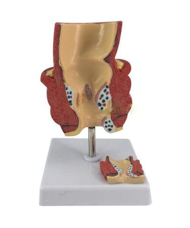 YOtat Human Pathological Hemorrhoids Model-Colorectal Hemorrhoid Lesion Model-Placed On The Base-is The Best Teaching Aid for Doctor-Patient Communication