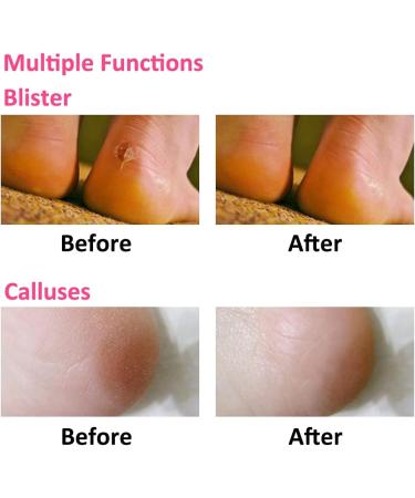 MICPANG Gel Heel Protectors for Plantar Fasciitis & Cracked Heel - Moisturizing Cushion Pads for Women and Men - Buy Online on GoSupps.com