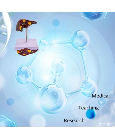 ARAZI Human Liver Pathology Model Visualization of Liver Lesions Clear Details Medical Teaching Props for Doctor-Patient Communication - Buy Online on GoSupps.com