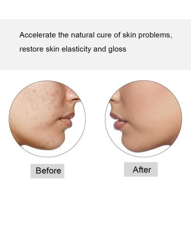 Professional Blue Light Therapy Pencil for Face Stain Removal - Scar, Acne, Wrinkle Treatment - Buy Online on GoSupps.com