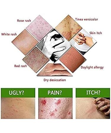 6PCS Chinese Herbal Eczema Psoriasis Creams for Dermatitis & Pruritus - CEZUBEM Ointment - Buy Online on GoSupps.com