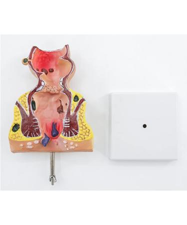 Human Anorectal Pathology Model Hemorrhoid Lesion Model Proctology Hemorrhoid Anal Fistula Lesion Model for Medical Teaching/Education Supplies - Buy Online on GoSupps.com