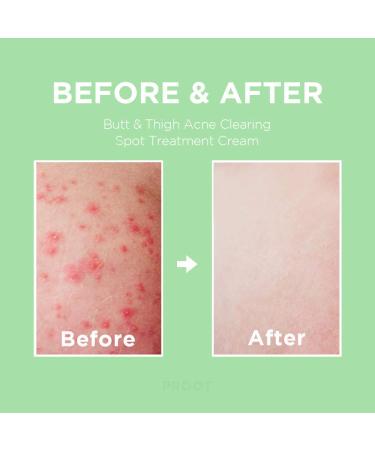 Travel-Friendly Butt Acne Treatment Cream | Clears Acne, Ingrown Hairs, Razor Bumps, and Dark Spots | Prevents Breakouts | For Butt, Thigh, and Sensitive Areas - Buy Online on GoSupps.com