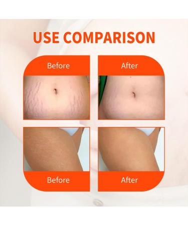 Laluerck Stretch Marks Oil for Pregnancy - Collagen Boost Firming & Lifting - Advanced Non-Greasy Skin Care - Buy Online on GoSupps.com