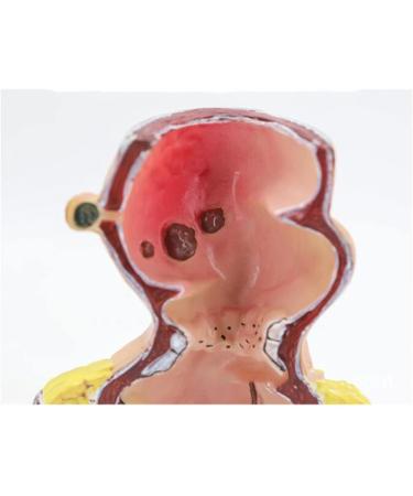 Human Anorectal Pathology Model Hemorrhoid Lesion Model Hemorrhoid Anal Fistula Lesion Model Rectal Medical Education/Product Education - Buy Online on GoSupps.com