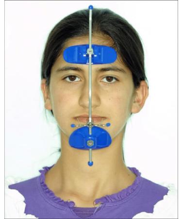 Sino Dental Orthodontic Multi-Adjustable High-Pull Reverse Facemask for Orthodontic Treatment - Blue | International Shipping Available - Buy Online on GoSupps.com