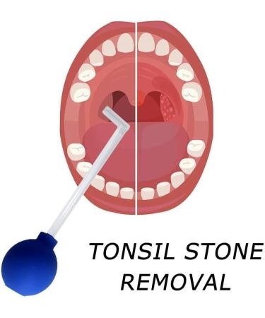 Portable Tonsil Stone Remover Kit - Oral Suction Tool for Adults (Purple) - Buy Online on GoSupps.com