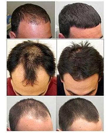  EXCELDIET PHARMA Hair Loss for Men and Women - Hair and Nails - High-Dosed Hair Food Supplement with Methionine and Cysteine Vitamins - 120 Vegetable Capsules Made in France - Buy Online on GoSupps.com