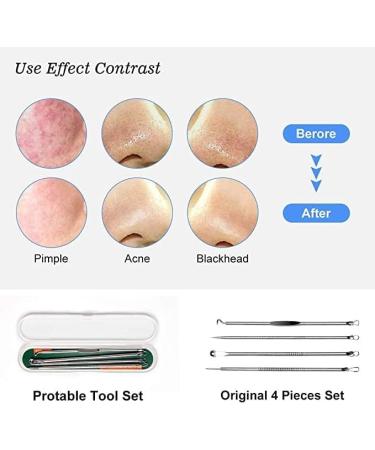 4PCS Blackhead Remover Tool Set for Acne, Comedone, Pimples, Spot, and Zit Extraction - Buy Online on GoSupps.com