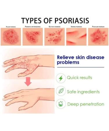 Eczema & Psoriasis Cream - Natural Relief for Dry, Itchy Skin | Scalp Rash Redness Acne - Buy Online on GoSupps.com