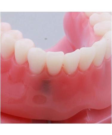 Fhuili Teeth Model for Education | Dental Implant Repair & Communication | Red Dentition Simulation Tool - Buy Online on GoSupps.com