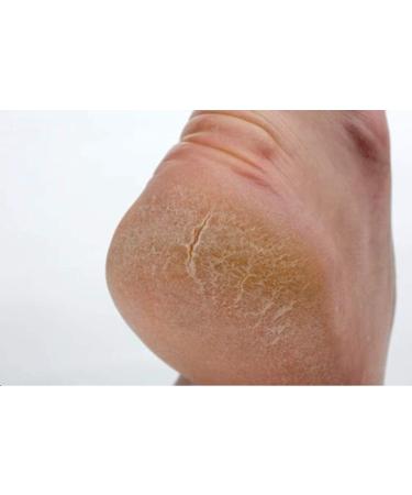 Natural Healing Tea Tree Ointment 60ml - Nail Infections, Athlete's Foot, Odor Relief - Buy Online on GoSupps.com