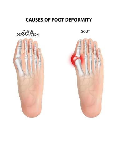 Bunion Sleeves Corrector for Men & Women - Big Toe Straightener Hallux Valgus Splint | Gel Pads & Foot Care Kit for Pain Relief (Beige - Buy Online on GoSupps.com