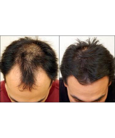 Nutrifolica Hair Loss Volumizing Conditioner 2 Month Supply | International Shipping Available - Buy Online on GoSupps.com