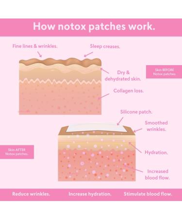 Notox Mouth + Smile Lines - Nudie Face 100% Medical Grade Silicone Wrinkle Patches | Reusable Silicone Patches To Reduce Mouth and Smile Lines | Fine Line & Wrinkle Reduction | Fast Results - Buy Online on GoSupps.com