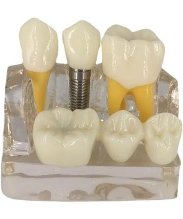 4x Dental Implant Teeth Model with Removable Crown - Crown & Bridge Dentist Training Tool for Patient Analysis | International Shipping - Buy Online on GoSupps.com