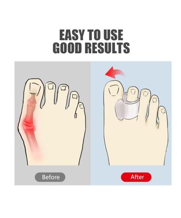 Women's Bunion Corrector & Toe Separator Set - Gel Toe Spacers for Pain Relief & Pressure Prevention (6-Pack) - Buy Online on GoSupps.com