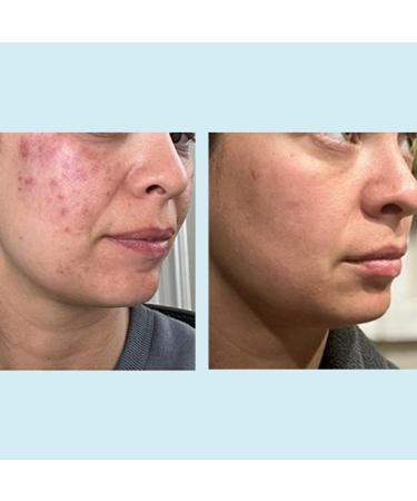 Glycolic Acid 50% Gel Peel - Enhanced with Retinol & Green Tea Extract (Professional Skin Peel)1 ounce 50% Strength - Buy Online on GoSupps.com