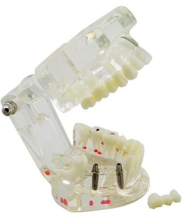 Denshine Dental Implant Disease Teeth Model - Restoration & Bridge Tooth for Dental Education & Training - Buy Online on GoSupps.com