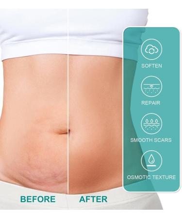 Advanced 20ml Scar Removal Spray - Fast & Gentle Fade for Tummy, Skin Burn, Old and New Scars - Repair Cream Care - P0T5 Stret - Buy Online on GoSupps.com