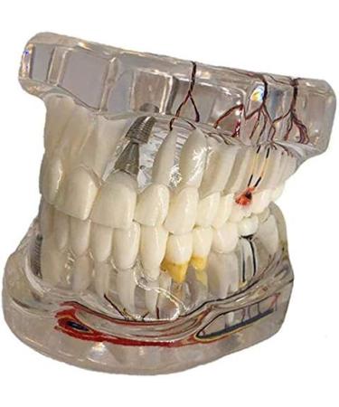Model of Tooth Disorders Transparent Adult Teeth Dental Model of Teeth Tooth Removable Prosthetics Teeth Demonstration Model for Teaching Transparent - Buy Online on GoSupps.com