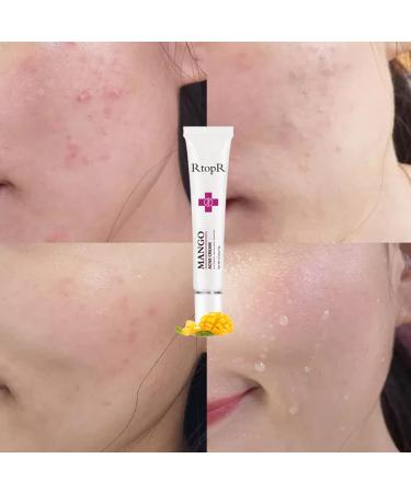 Easilydays Mango Acne Cream: Pimple & Scar Treatment for Moisturized Skin, Pore Reduction & Acne Scar Removal - Balances Water & Oil - Buy Online on GoSupps.com