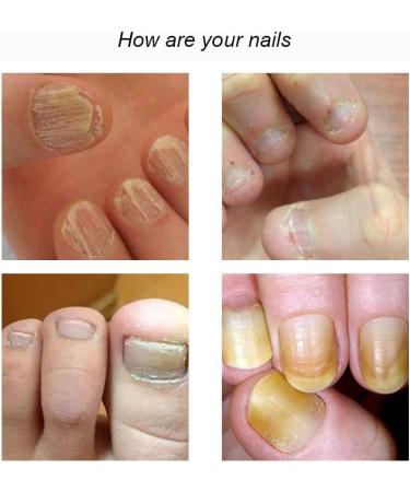 7 Days Nail Growth and Strengthening Serum 1/2/3/5 bottles Nail Strengthener and Growth Serum (5 bottles) - Buy Online on GoSupps.com