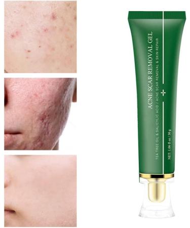 acne removal cream Acne Scar Removal Gel Face Body Marks Skin Repair Cream Acne Treatment Essence 30g - Buy Online on GoSupps.com