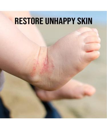 Mendy Dry Skin Cover | Natural Eczema Cream Alternative | Gentle Eczema Therapy Patch | Moisturizer for Baby, Kids & Adults - Buy Online on GoSupps.com