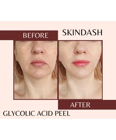 Professional 70% Glycolic Acid Peel for Youthful Glow and Skin Revitalization - Erase Wrinkles, Boost Collagen, Shrink Pores, and Fade Acne Scars at Home - Buy Online on GoSupps.com