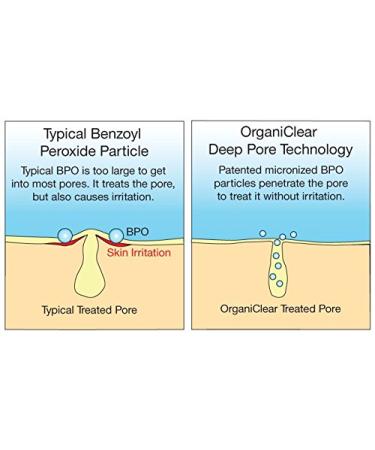 OrganiClear Acne Treatment System Kit - Benzoyl Peroxide Cream, Salicylic Acid Face Wash, Soothing Lotion - 90-Day Complete Skin Care Set - Buy Online on GoSupps.com