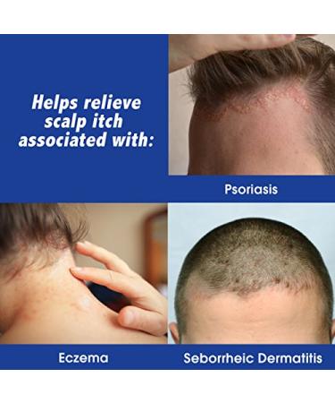 Scalpicin Max Strength Scalp Itch Treatment 1.5 oz - Pack of 3 - Buy Online on GoSupps.com