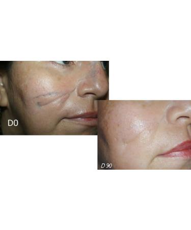 SODERMIX For scar treatment - 30 g. - Buy Online on GoSupps.com