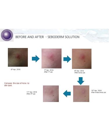 Buy Acne Seboderm Solution - Anti Sebum Treatment for Blemish-Prone Skin | Pore Shrinking Care Worldwide Shipping - Buy Online on GoSupps.com