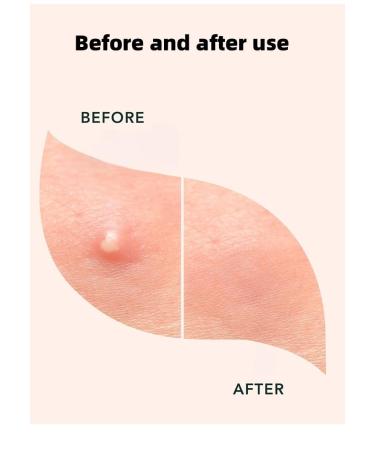 Invisible Pimple Patches - Hydrocolloid Acne Treatment for Quick Healing & Smooth Skin | 36ct (2 Sizes - Buy Online on GoSupps.com
