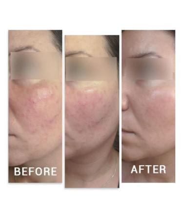 ZustBeauty 3-in-1 Derma Roller Kit with 0.3mm Titanium Microneedling Heads, Vitamin C Serum & Collagen Cream - Buy Online on GoSupps.com