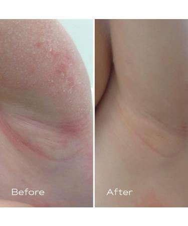 KAMEDIS Eczema Therapy Cream for Atopic Dermatitis, Sensitive & Irritated Skin 5.07 fl. Oz - Buy Online on GoSupps.com