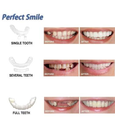Instant Snap Veneers: Teeth Socket Perfect Braces & Whitening Alternative - No Pain, No Shots, No Drilling (1 Upper + 1 Lower + 2 Adhesives) - Buy Online on GoSupps.com
