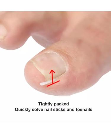 Toe Correctors 10/20/30/50pcs - Pressure Relief for Ingrown Nails - Universal Black - Fast International Shipping - Buy Online on GoSupps.com