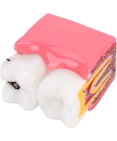 Buy Caries Comparison Study Models | Dental Anatomy Teeth Models for Dentist Education - International Shipping - Buy Online on GoSupps.com