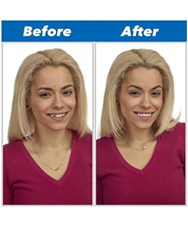 Instant Perfect Smile Kit | SHOP-STORY Replacement Tooth - Reusable & Removable | International Shipping Available - Buy Online on GoSupps.com