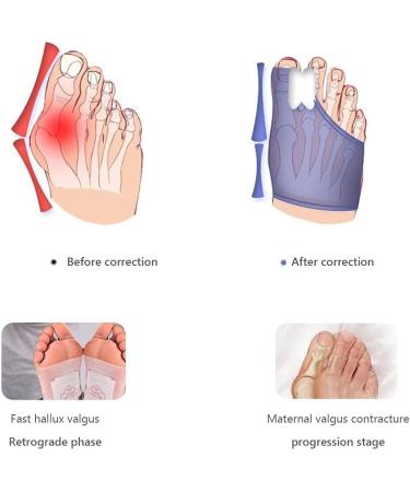 Kenanlan Bunion Corrector for Women - 2PC Toe Splints & Separators for Overlapping Big Toe - Universal Size - Buy Online on GoSupps.com