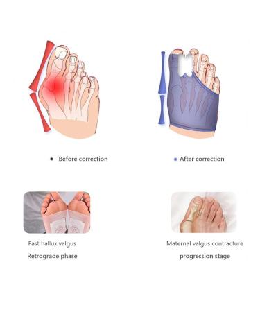 Urisgo Hallux Valgus Correction: Orthopedic Bunion Rail for Great Toe Pain Relief & Support - 2 Pieces for Day/Night Use - Buy Online on GoSupps.com