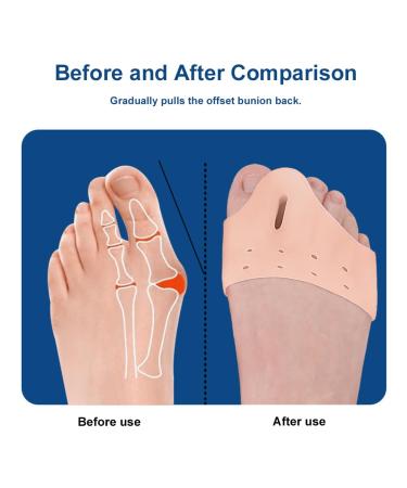 Asieit Midfoot Cushion & Toe Spreader - Pain Relief Foot Care Tool for Bunions Overlapping Toes & Pedicure | Soft Breathable Comfort - 1 Pair - Buy Online on GoSupps.com